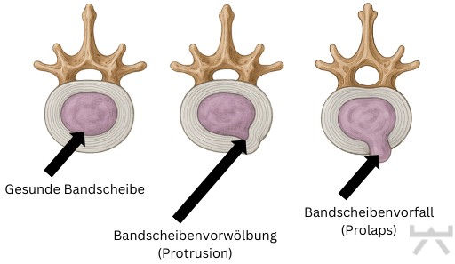 Gesunde Bandscheibe (2)