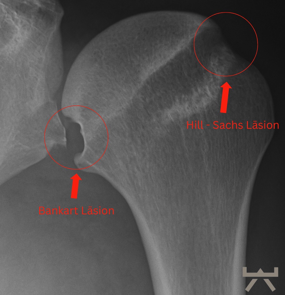 In dem Bild sieht man eine Hill-Sachs-Läsion (die Delle im Schulterkopf) und eine Bankart-Läsion (Fraktur am unteren Ende der Schulterpfanne).