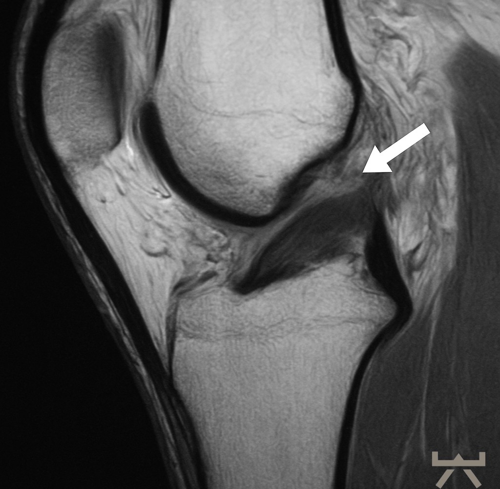 Kreuzbandriss MRT Kreuzbandriss MRT