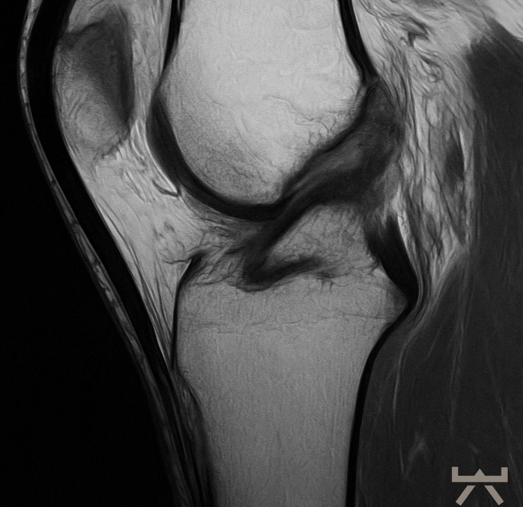 Kreuzbandriss verheilt nach 2 Jahren Kreuzbandriss verheilt nach 2 Jahren